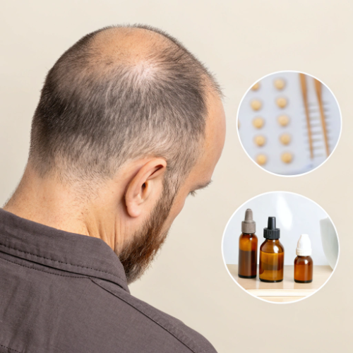 calvicie-en-la-coronilla